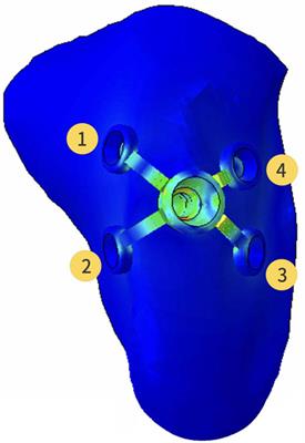 Frontiers Biomechanical Evaluation Of Custom Made Short Implants With